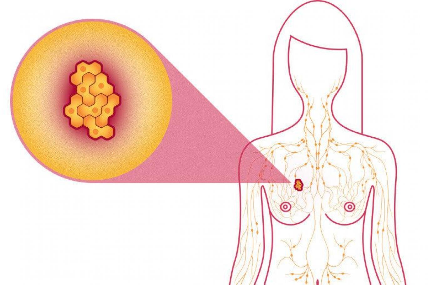 الثدي سرطان سَرطان الثدي