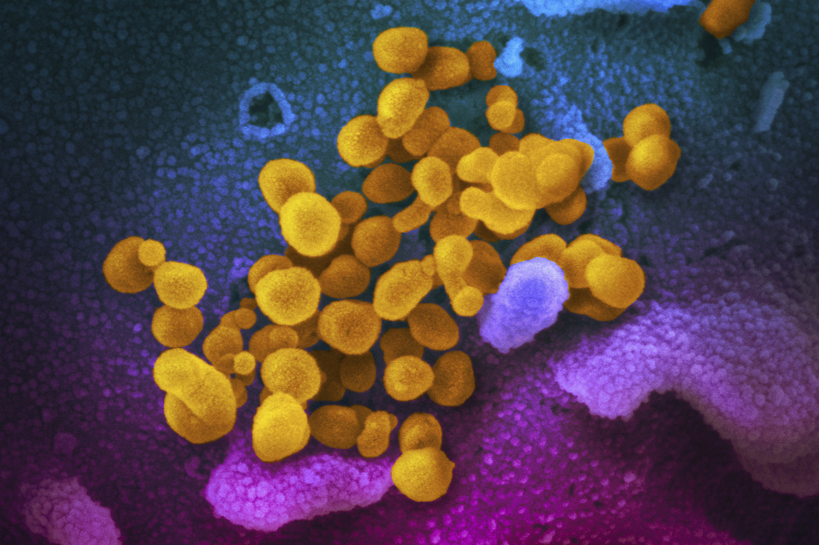صورة ملونة ملتقطة بالميكروسكوب الإلكتروني نشرتها "معاهد الصحة الوطنية" الأميركية في فبراير 2020، تظهر فيروس "إن سارس كوف 02" (باللون الأصفر) بعد عزله في المختبر من مريض عانى أعراض كوفيد الطويل الأمد 