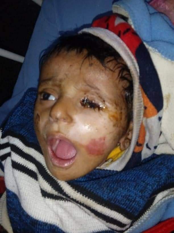 الطفلة شهد بعد أن تضررت عينها بسبب خطأ طبي (اندبندنت عربية)