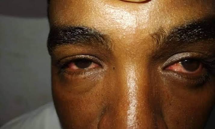 الأمراض الفتاكة تحاصر نازحي السودان