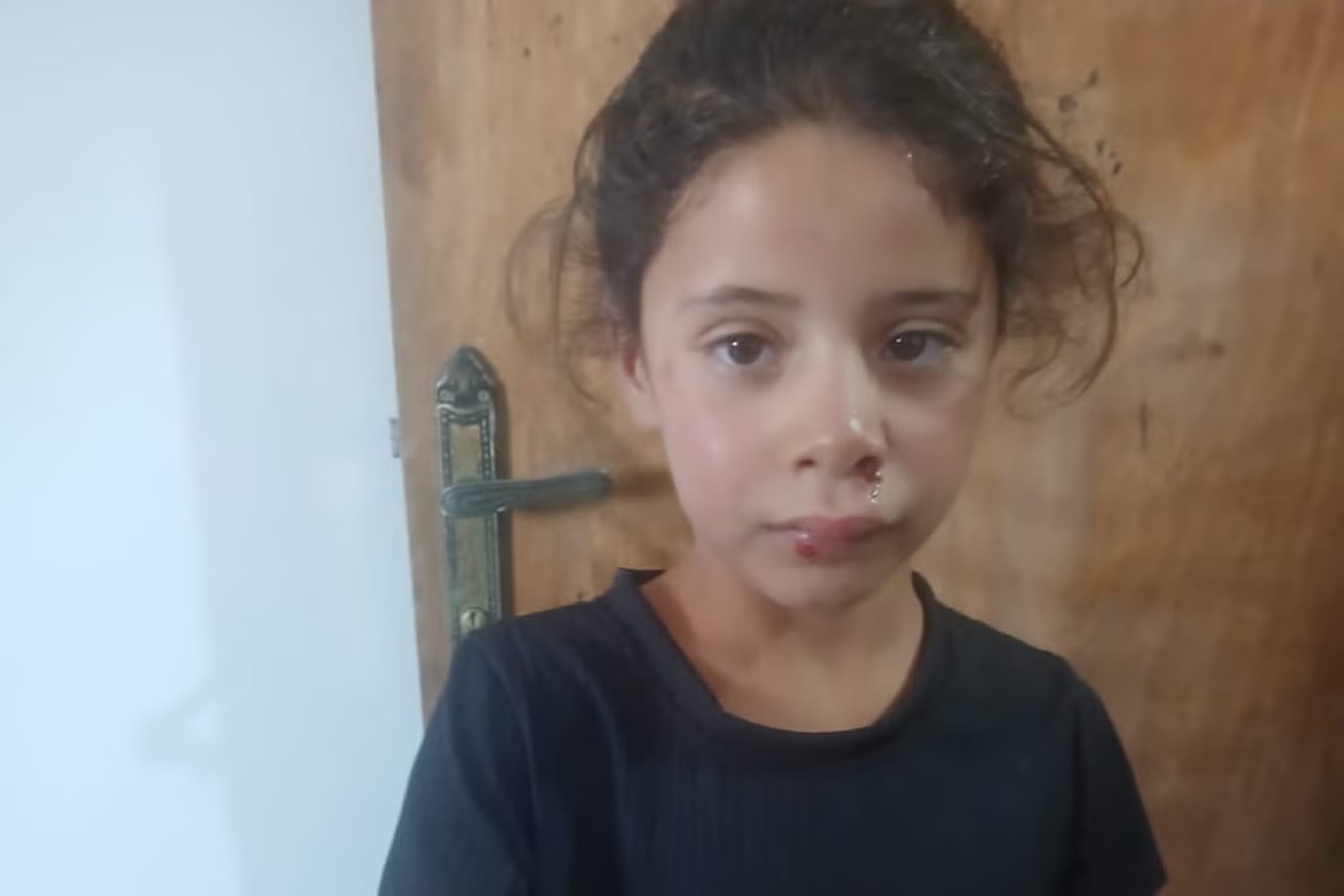 رزان الفتاة الفلسطينية البالغة من العمر 8 سنوات، أصيبت بجروح في وجهها بعدما تعرضت للرشق بحجر خلال الهجوم (رضوان أبو جندية)